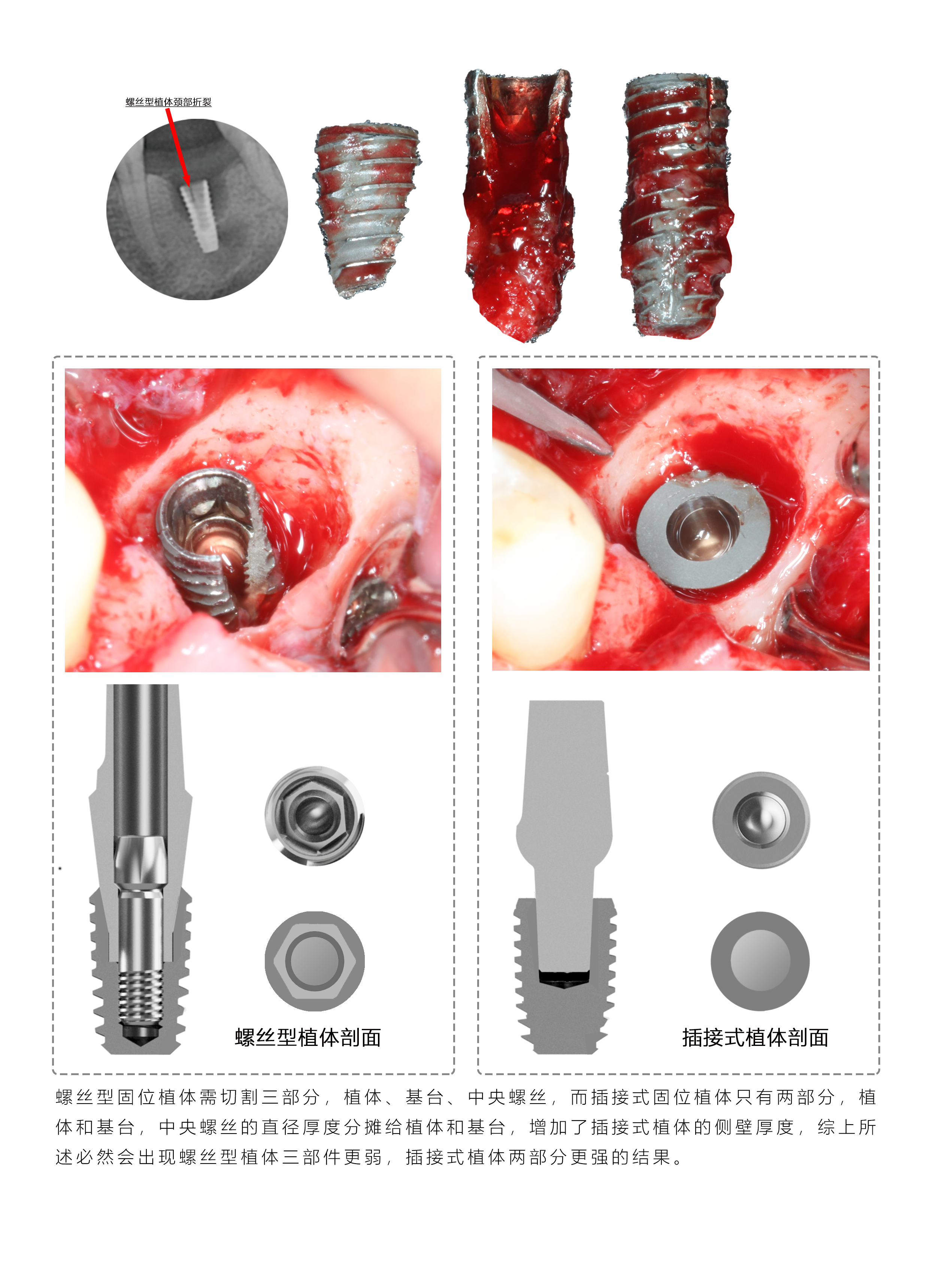 螺丝型病发症